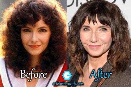 Mary Steenburgen Plastic Surgery Before and After